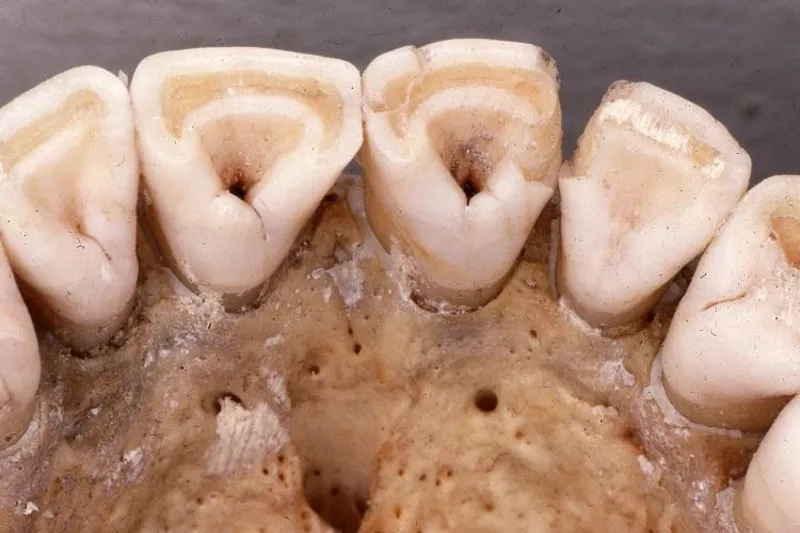 skovlformede tænder