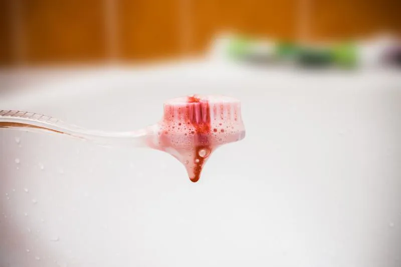 Blødning ved tandbørstning