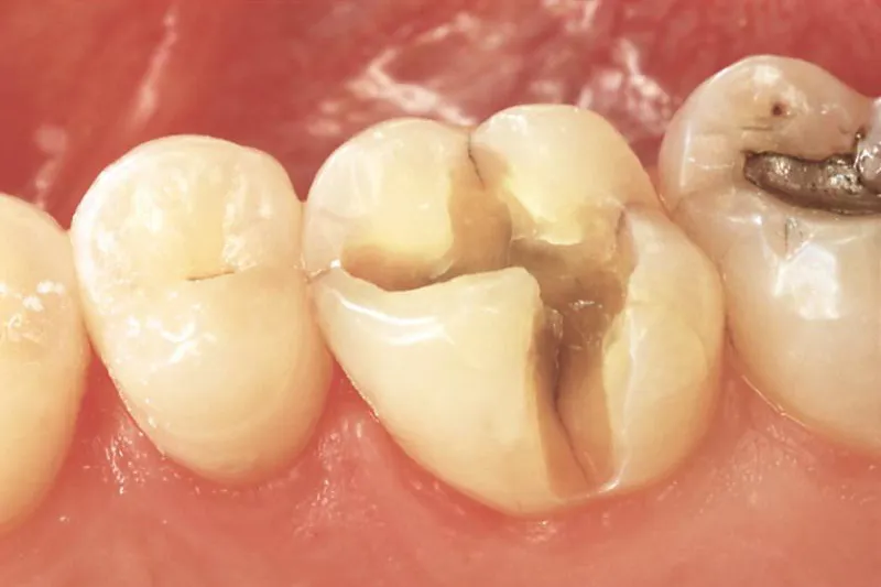 Revner i en kindtand hvor der tidligere har vaeret en mindre fyldning