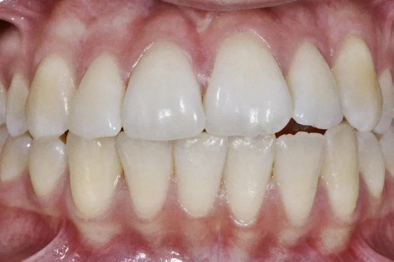 A721 Behandling af trangstilling