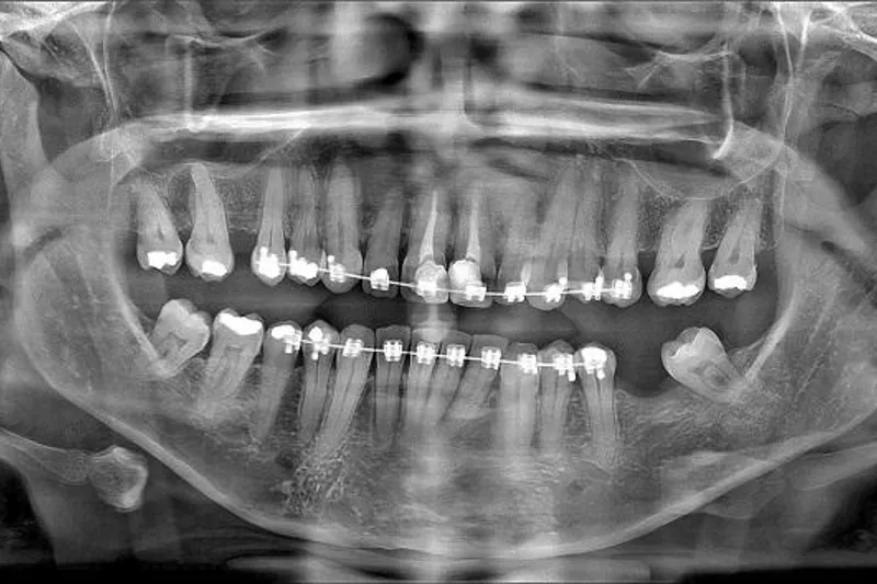 Panoramabillede zygoma
