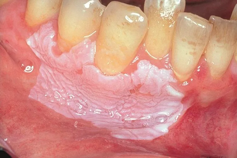 Oral leukoplaki