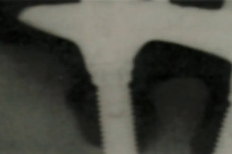 Peri-implantitis