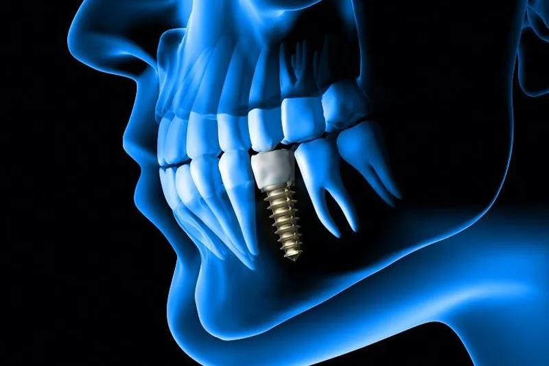 Implantatbehandling
