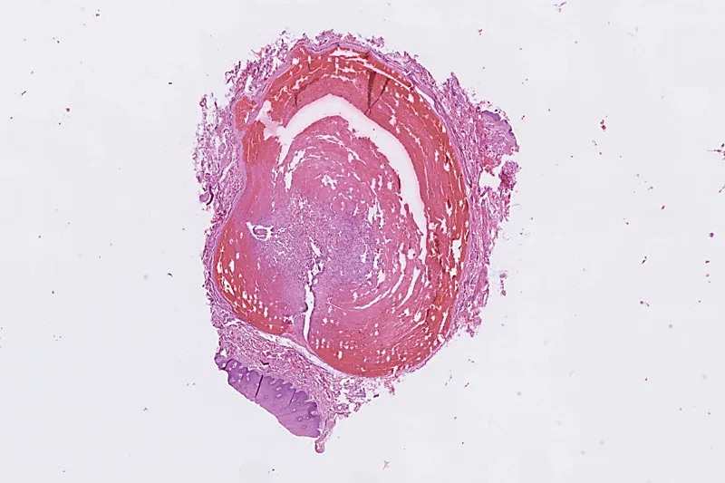 A761 Masson's tumor