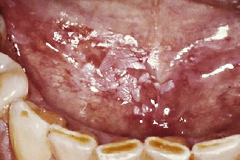 Mund- og tandskader hos cancerpatienter