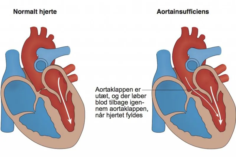Aortainsufficiens