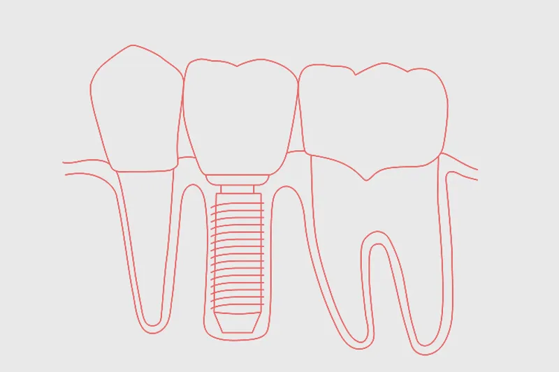 Implantat