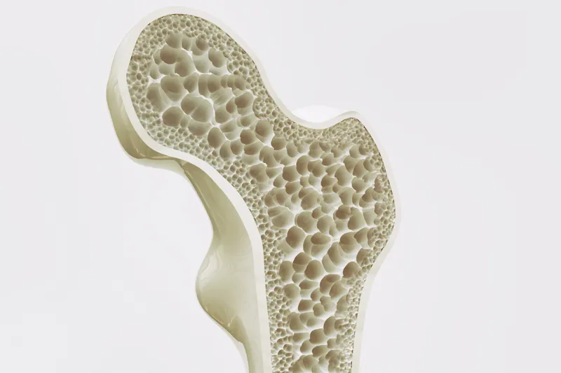 Osteoporosis stage 4 of 4 - 3d rendering