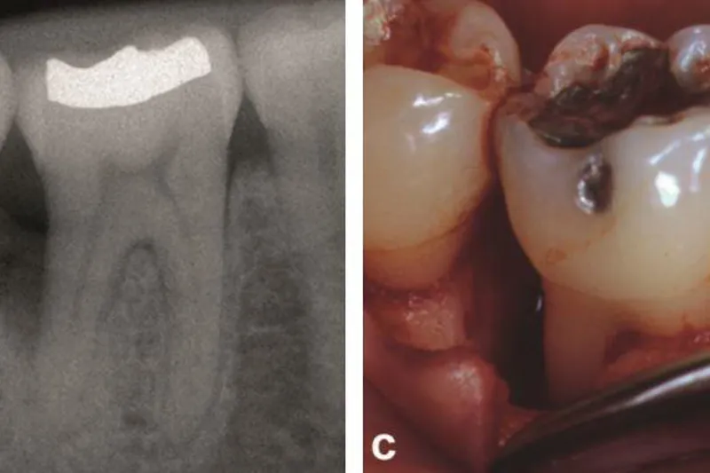Parodontal regeneration