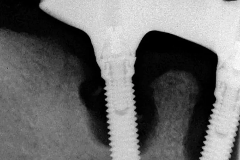 Røntgen implantat
