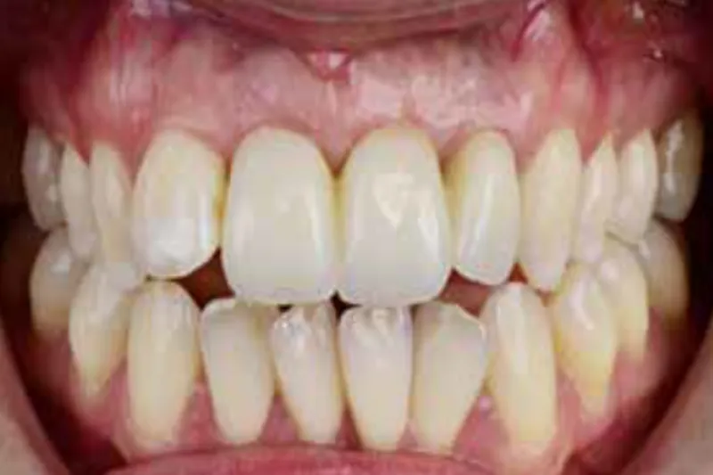 Zirconia