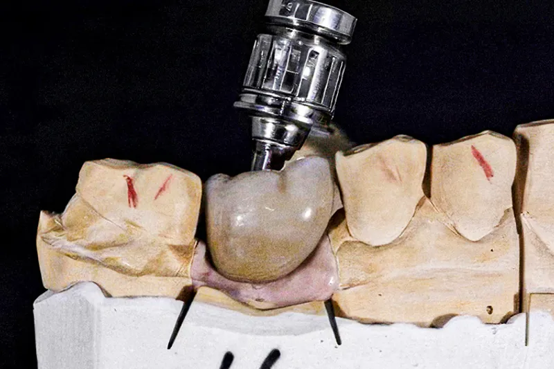 TB2024 04 Ny Viden Implantat