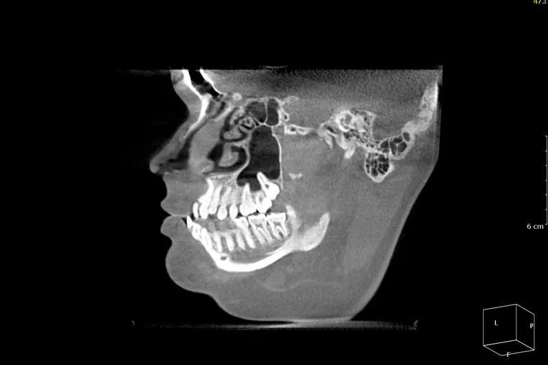 CBCT
