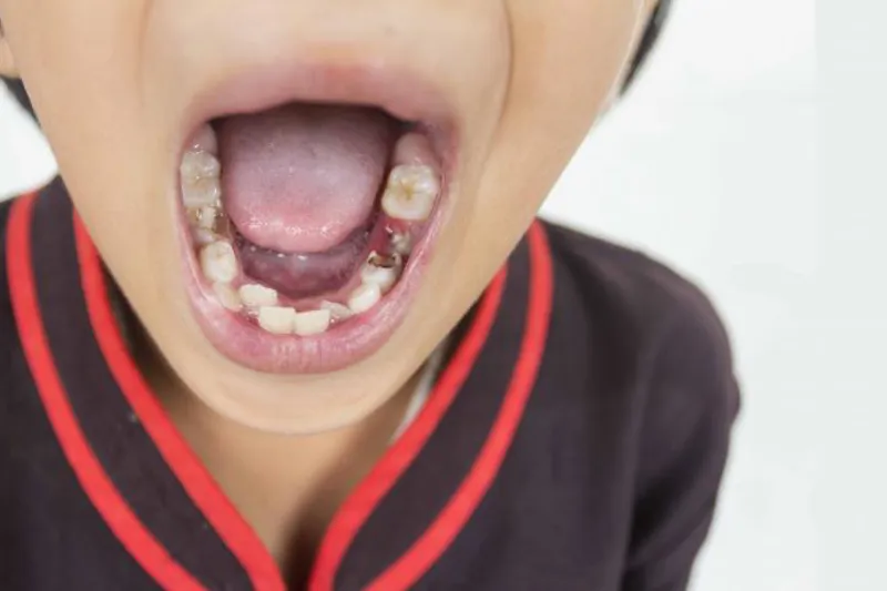 Ulighed børnetandpleje caries