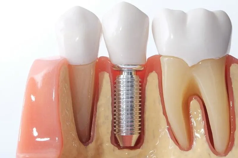 Implantatbehandling
