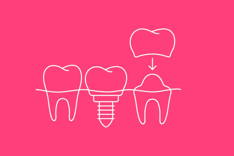 DFN195 Implantat Og Krone Version 1