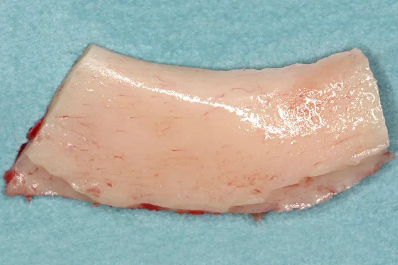 Knoglebrok fra mandiblen