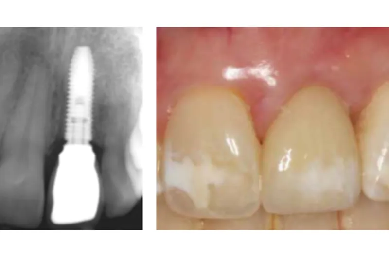a556 fig. 6
