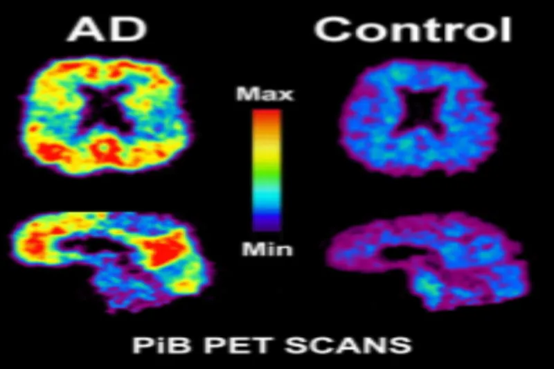 Amyloid pet-scanning
