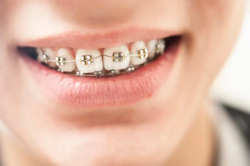 Sagittale afvigelser