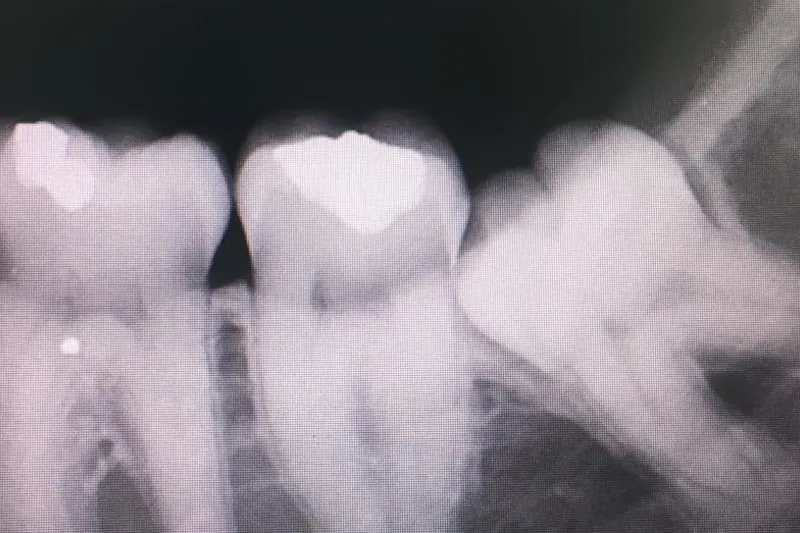 Retineret molar